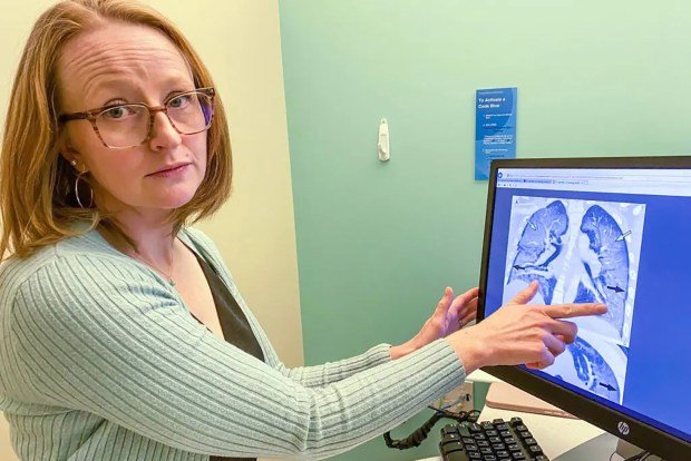 Gençken elektronik sigara kullanmaya başlayan birçok genç yetişkin bu alışkanlığı bırakamıyor 1 Heather De Keyser, a pediatric pulmonologist at Children's Hospital Colorado, points to the X-ray of a lung of a young adult damaged by vaping. (John Daley/Colorado Public Radio/TNS)